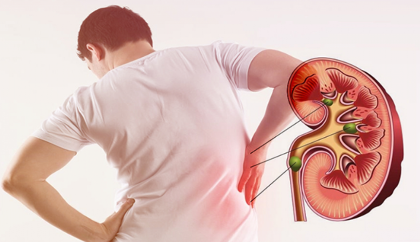 Unicanxi V99: Giải Pháp Canxi An Toàn và Hiệu Quả Cho Người Bị Sỏi Thận