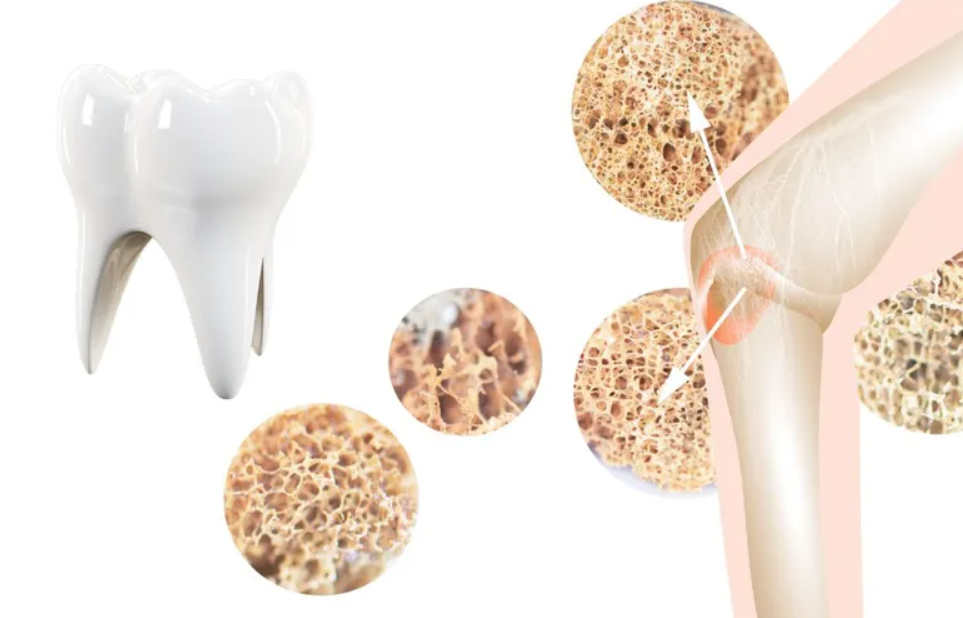 Unicanxi V99: Giải Pháp Canxi An Toàn và Hiệu Quả Cho Người Bị Sỏi Thận