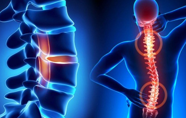 Cách Sử Dụng Unicanxi V99 Để Hỗ Trợ Điều Trị Viêm Khớp, Loãng Xương