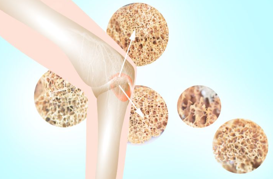 Cách Sử Dụng Unicanxi V99 Để Hỗ Trợ Điều Trị Viêm Khớp, Loãng Xương