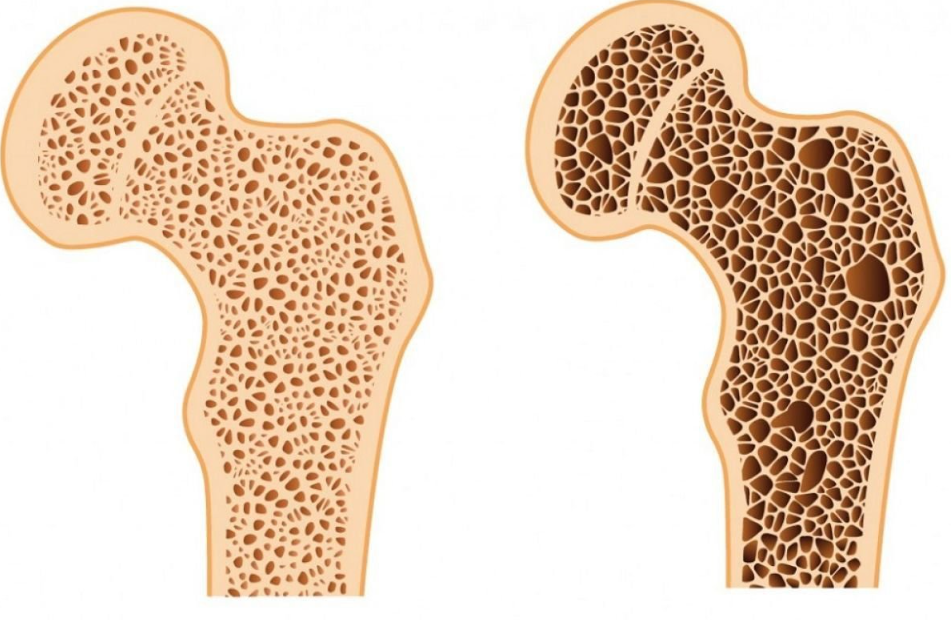 Unicanxi V99 – Sản Phẩm Đột Phá: Canxi Lactate Giúp Tăng Mật Độ Xương, Giảm Nguy Cơ Xốp Xương